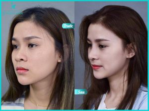 nang-mui-tai-jk-nhat-han
