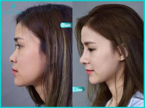 nang-mui-sline-dep