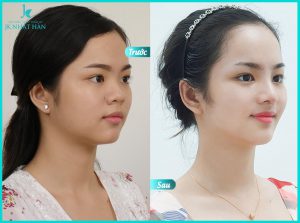nang-mui-cau-truc