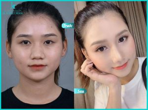 Nâng mũi cấu trúc