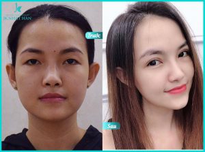 đôi mắt đẹp hơn sau khi nhấn mí mắt tại JK Nhật Hàn