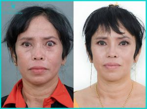 chinh-mat-lat-mi-sau-pt