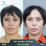 Giải cứu mắt hỏng thành công khách hàng vỡ òa trong hạnh phúc
