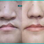 PHƯƠNG PHÁP THẨM MỸ MÔI SỨT MÔI HỞ HÀM ẾCH MAGIC LIPS