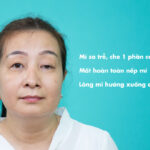 Phẫu thuật mắt to mắt nhỏ