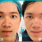 Cắt mắt sụp mí bao nhiêu tiền, tham khảo giá phẫu thuật mắt sụp mí