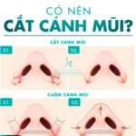 Có nên cắt cánh mũi? Đâu là phương pháp thu gọn cánh mũi phù hợp với bạn?