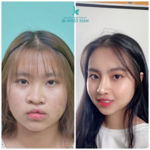 Tài trợ đến 50% chi phí phẫu thuật sứt môi hở hàm ếch tại JK Nhật Hàn