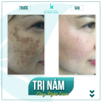 Bí quyết điều trị nám da nhanh chóng, an toàn
