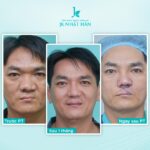 Bệnh hở hàm ếch và những điều cần biết