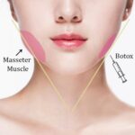 Botox thon gọn hàm - Bí quyết cằm V-line không đau