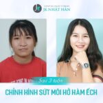 Sứt môi có di truyền hay không? Điều phải biết