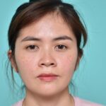 Từ A-Z bí quyết xoá mũi tẹt cần biết ngay kẻo lỡ!