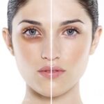 Cách trị thâm quầng mắt hiệu quả
