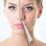 Tuyệt chiêu trị thâm mụn cấp tốc hiệu quả