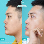 Nâng mũi bao nhiêu ngày hết sưng và đẹp tự nhiên?