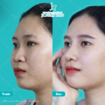 Chia sẻ kinh nghiệm nâng mũi từ A đến Z cho những ai chưa biết