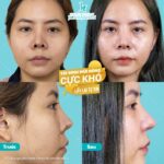 Top 05 Cách nâng mũi cao Tự Nhiên ĐẸP VĨNH VIỄN