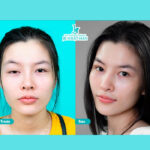 Các loại sụp mí mắt bẩm sinh có thể bạn chưa biết