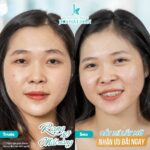 Thẩm mỹ cắt mí mắt có ảnh hưởng gì không?