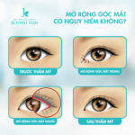 Mở rộng góc mắt có ảnh hưởng đến thị lực mắt?