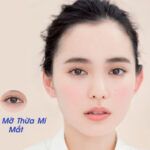 Thẩm mỹ lấy mỡ mắt có đau không? 