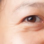 Bật mí những cách trị bọng mắt hiệu quả nhất hiện nay