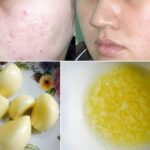 Top 7 cách trị mụn tại nhà hiệu quả với những nguyên liệu tự nhiên