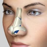 Thẩm mỹ thu nhỏ đầu mũi có vĩnh viễn không?