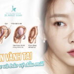 Nâng mũi bọc sụn tai có vĩnh viễn không?