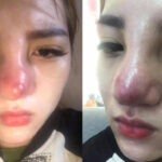 Có nên sửa lại mũi sau 1 tháng hay không?