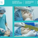 Nâng mũi bao lâu thì đầu mũi mềm tự nhiên?