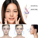 Chia sẻ kinh nghiệm nâng mũi chi tiết nhất từ A đến Z