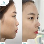 Bật mí giá phẫu thuật nâng mũi hiện nay trên thị trường