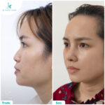 Nâng mũi bán cấu trúc giá bao nhiêu? Có mắc hay không?