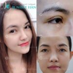 Cắt mí mắt có đau không? Phương pháp nào cắt mí ít đau và mau lành nhất?