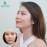 Nâng mũi cao hơn bình thường và những lưu ý bạn cần biết