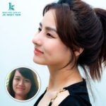 Ảnh nâng mũi đẹp - Phân biệt các công nghệ nâng mũi năm 2024