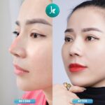 Sửa Mũi hỏng - Khắc phục mọi biến chứng 2023