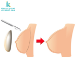 Nâng ngực cho con bú được không?
