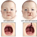 Sứt môi bẩm sinh xảy ra ở giai đoạn nào của thai kỳ?