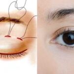 Nhấn mí giá bao nhiêu tiền? Các loại hình phẫu thuật nhấn mí hiện nay