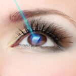 Nhấn Mí Laser là gì? Có hiệu quả không?