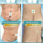 Nguyên nhân gây ra biến chứng hút mỡ bụng