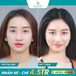Nhấn mí mắt là gì? Nên chuẩn bị gì trước và sau nhấn mí?