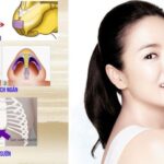 Nâng mũi sụn sườn giá bao nhiêu?
