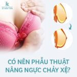Có nên phẫu thuật nâng ngực chảy xệ?