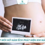 Sứt môi hở hàm ếch phát hiện khi nào? Giải pháp khi phát hiện bào tai dị tật