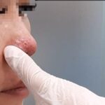 Bị mụn sau khi nâng mũi và cách điều trị