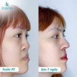  Bệnh Viện Thẩm Mỹ JK Nhật Hàn tài trợ 3 tỷ đồng phẫu thuật mũi môi dị tật